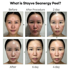 STAYVE SEANERGY PEEL AMPOULE 5X1,3g+5X8ml STAYVE SEANERGY PEEL AMPOULE 5X1,3g+5X8ml