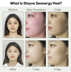 STAYVE SEANERGY PEEL AMPOULE 5X1,3g+5X8ml STAYVE SEANERGY PEEL AMPOULE 5X1,3g+5X8ml