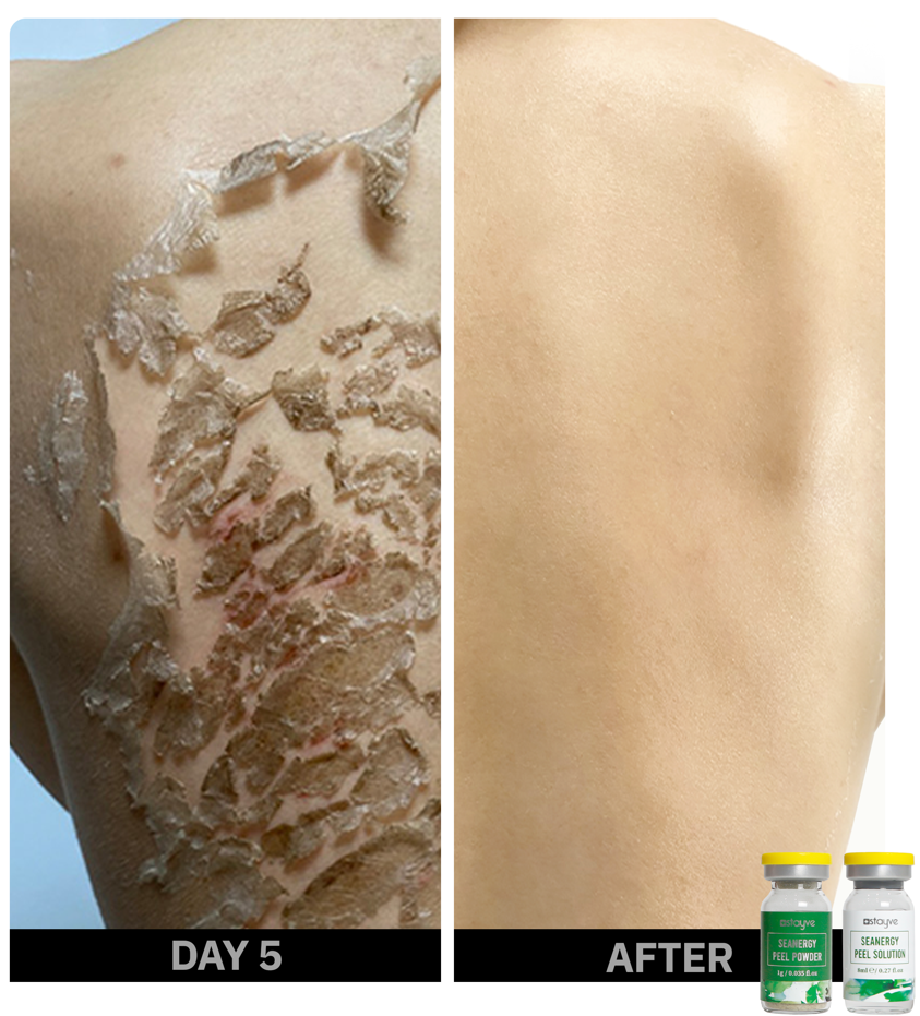 Seanergy Peel Before & After: The Ultimate Solution for Acne and Scar Treatment